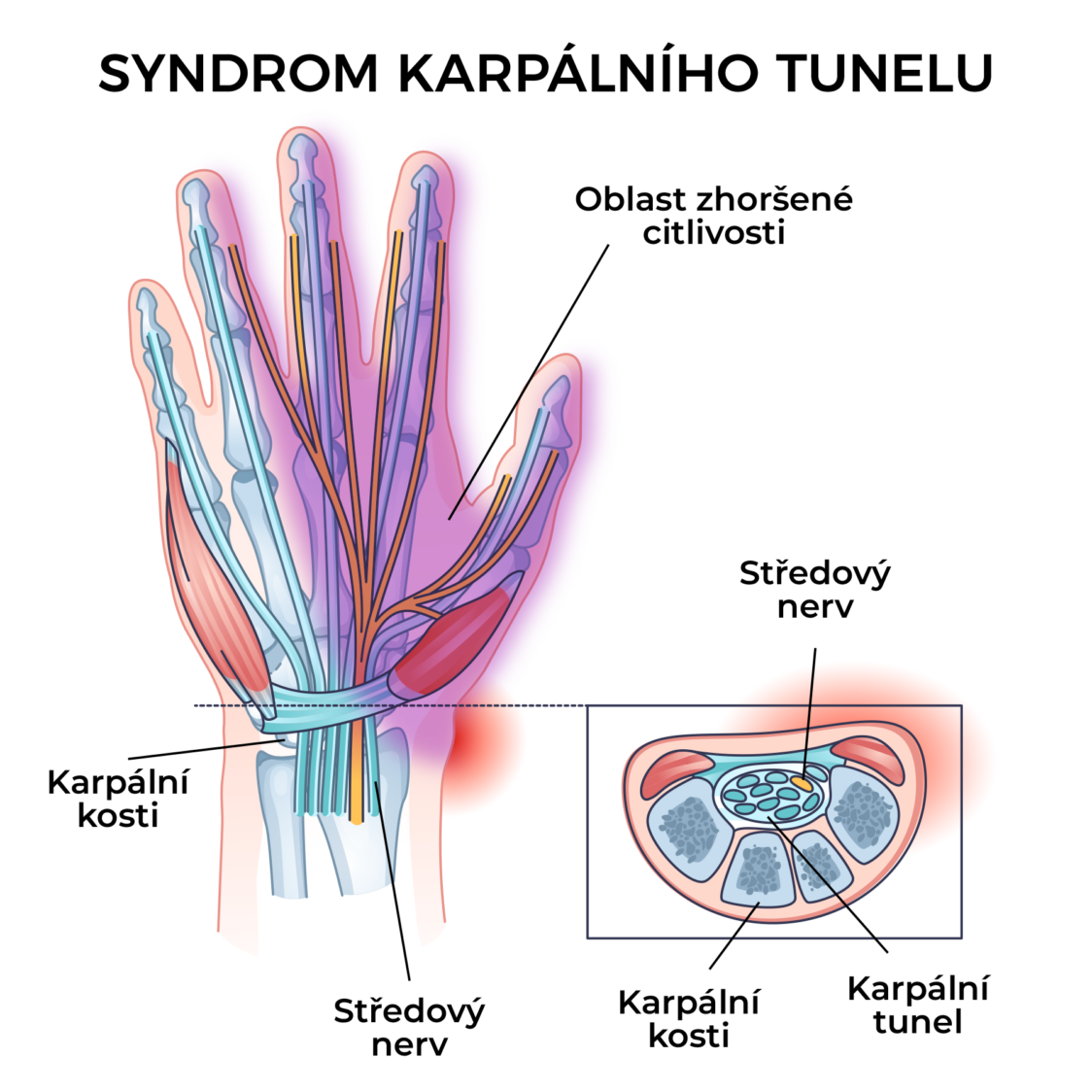 Syndrom karpálního tunelu
